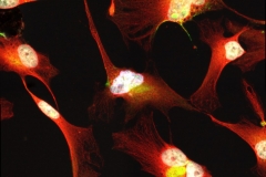 Glioma cells